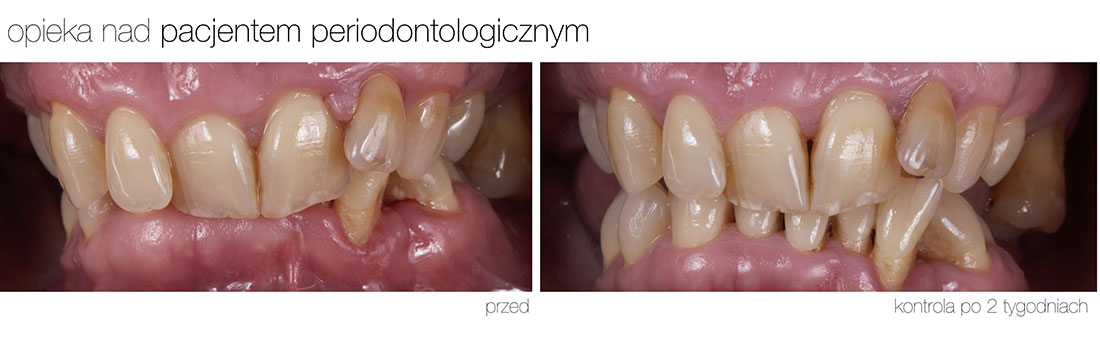 opieka periodontoza